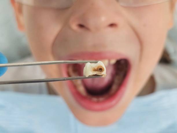 Best Emergency Wisdom Teeth Removal in Deerwood, TX